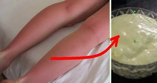 Cum sa tratezi arsurile solare cu ajutorul unui remediu facut in casa
