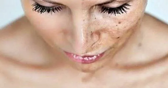 5 remedii care te scapa definitiv de pistrui