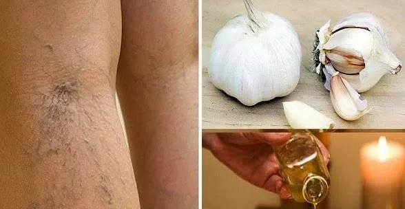 Afla cum poti trata varicele in mod natural. Cea mai eficienta metoda