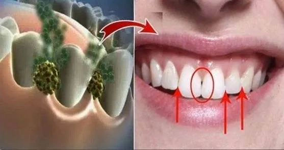 Elimina respiratia urat mirositoare in 5 minute! Acest remediu va distruge toate bacteriile care duc la aparitia acesteia