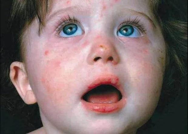Scarlatina la copii: Simptome, cauze, tratament si prevenire