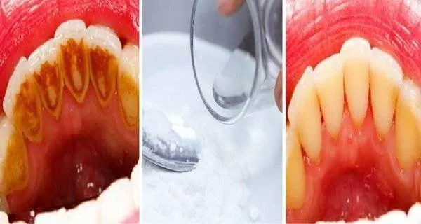 Apa de gura care indeparteaza tartrul dentar. O poti prepara la tine acasa