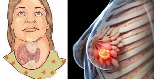 Bautura care iti distruge tiroida si care se afla in stransa legatura cu cancerul mamar 