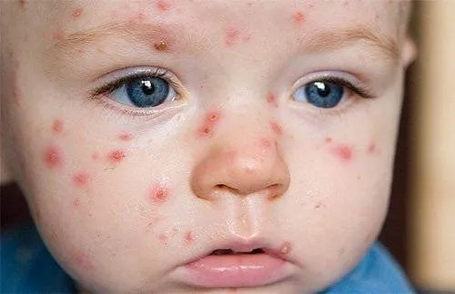 E bine sa ne vaccinam copiii impotriva varicelei?