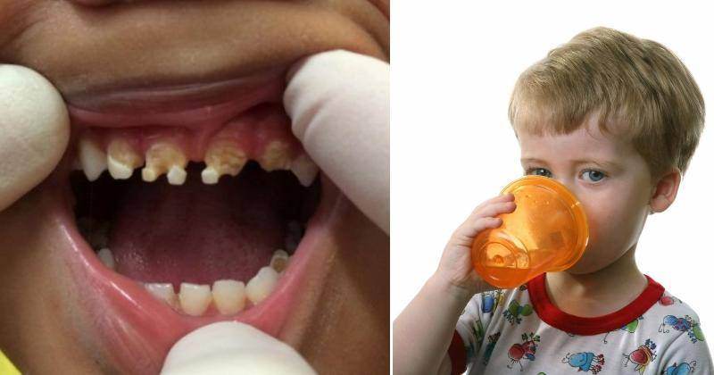 Parintii vor ramane socati! Motivul pentru care copiii au carii