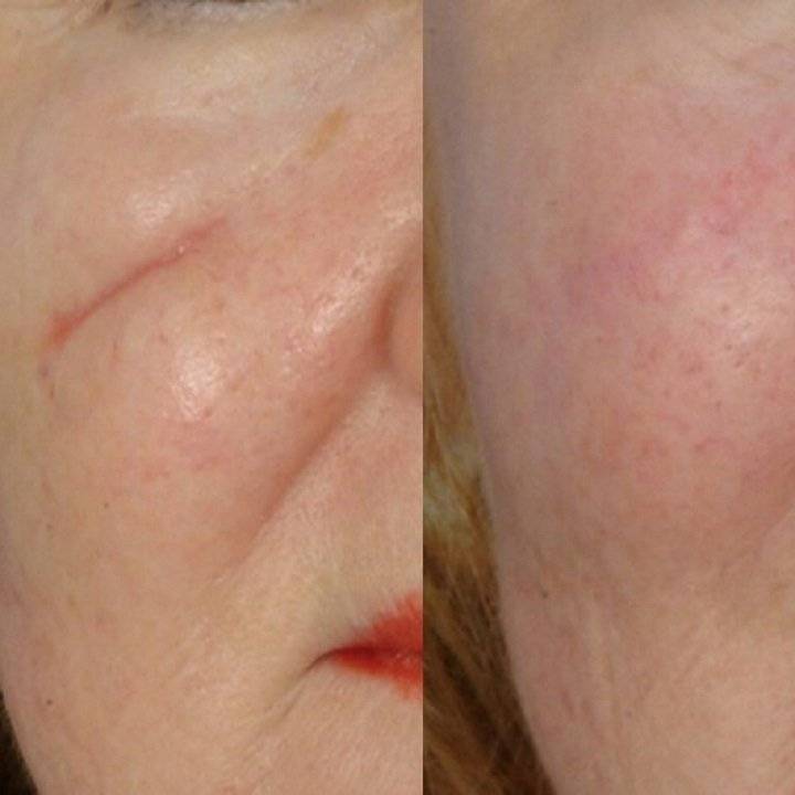 Iata care este secretul prevenirii cicatricilor! Cum sa scapi definitiv de ele