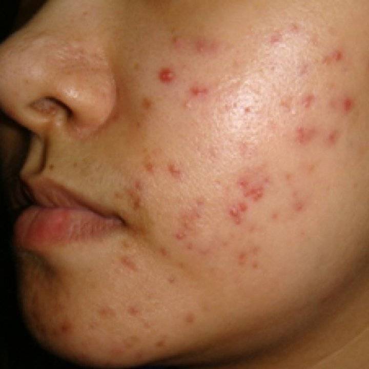 Acneea este mai periculoasa in timpul verii! Iata cum puteti scapa de ea