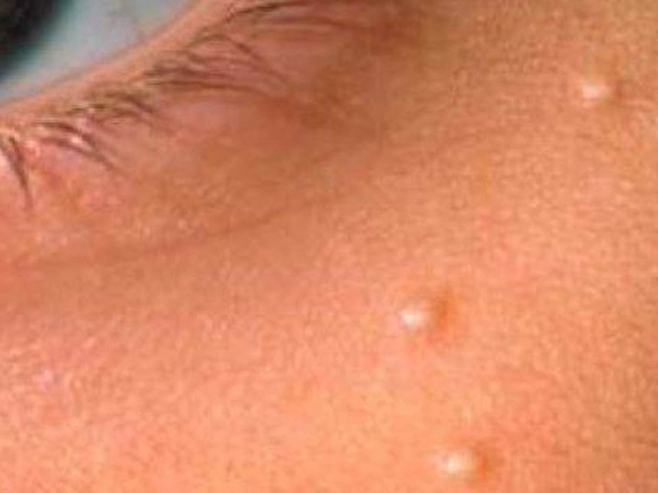 Cum sa scapi de punctele negre si punctele de grasime