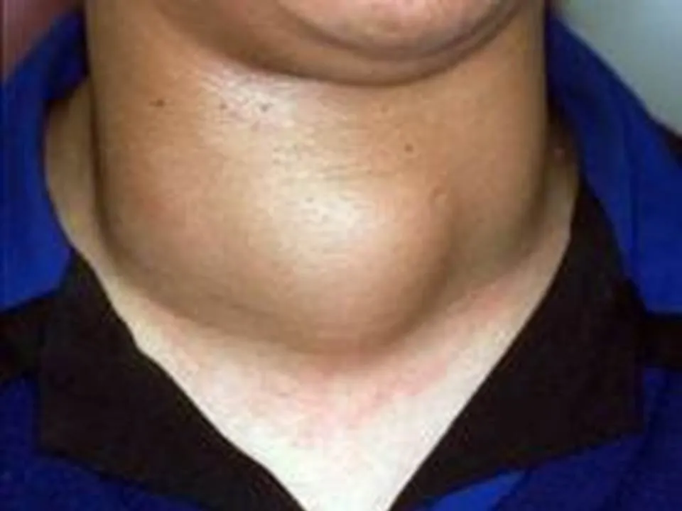 Semne ca ai probleme cu tiroida si ce poti face in privinta asta