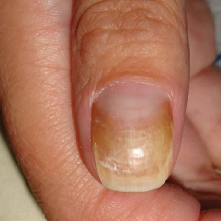 Uleiul natural care te vindeca de micoza unghiilor
