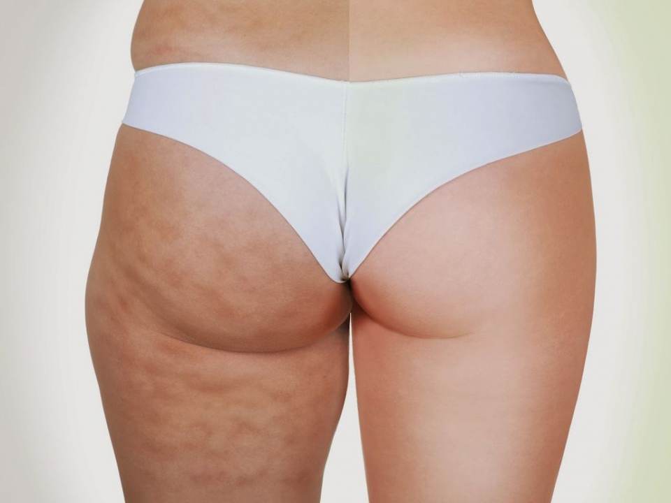 Cum combatem celulita!? ATENTIE – NU trebuie confundata cu grasimea