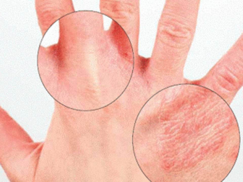 Cauzele obisnuite ale senzatiei de usturime