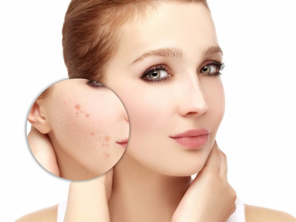 Scapa de acnee si iritatiile pieli cu aspirina