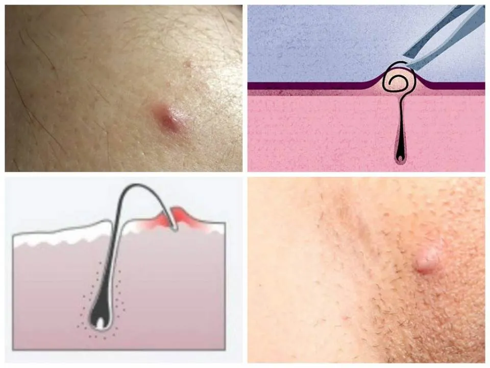 Remediul natural care te scapa de firele crescute sub piele