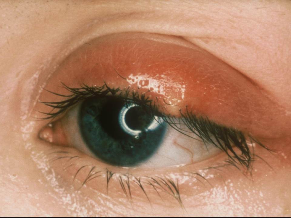 Cum sa tratezi urciorul de la ochi in mod natural