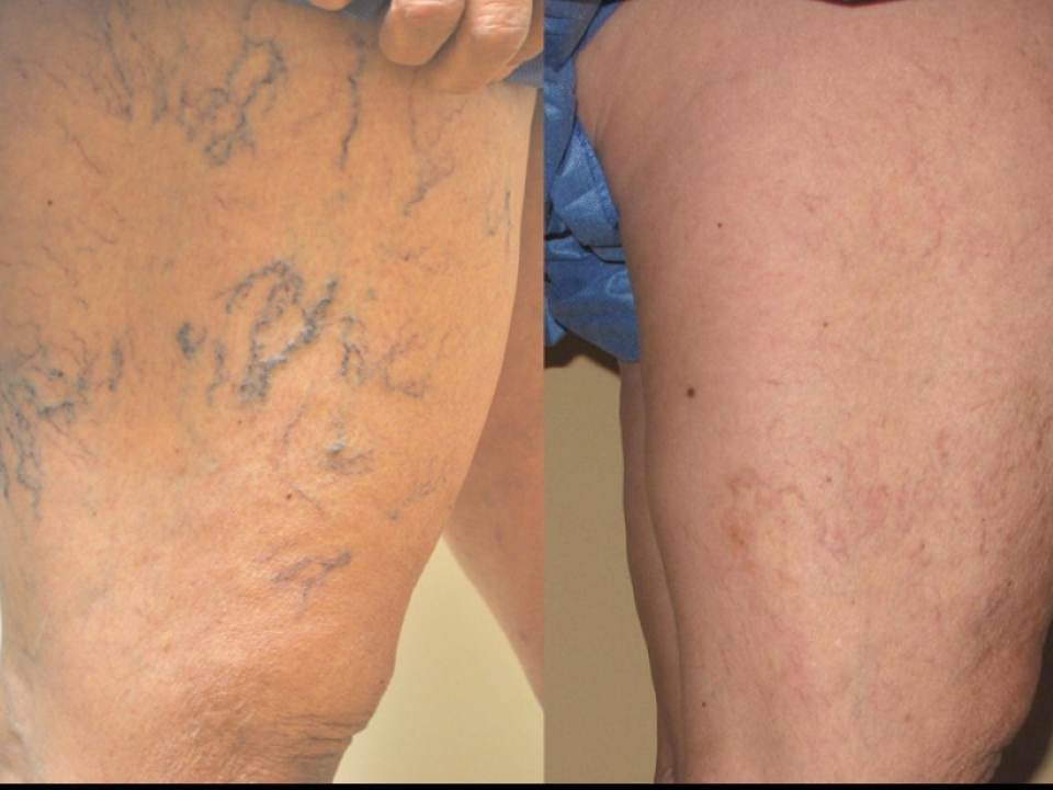 Cum sa preveniti aparitia varicelor