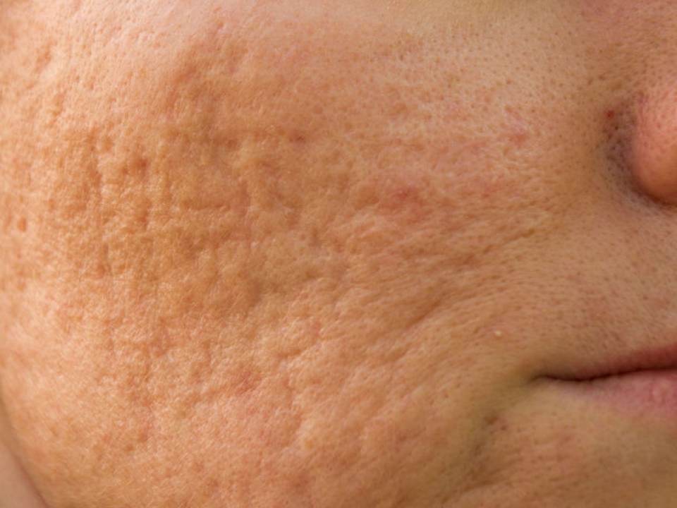 Cum sa obtii propriul gel pentru acnee