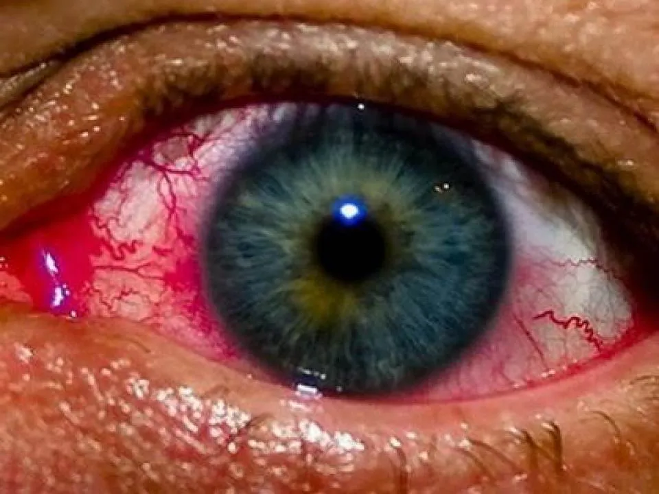 A facut cancer la ochi din cauza unui obicei pe care il avem cu totii! In fiecare noapte facea asta