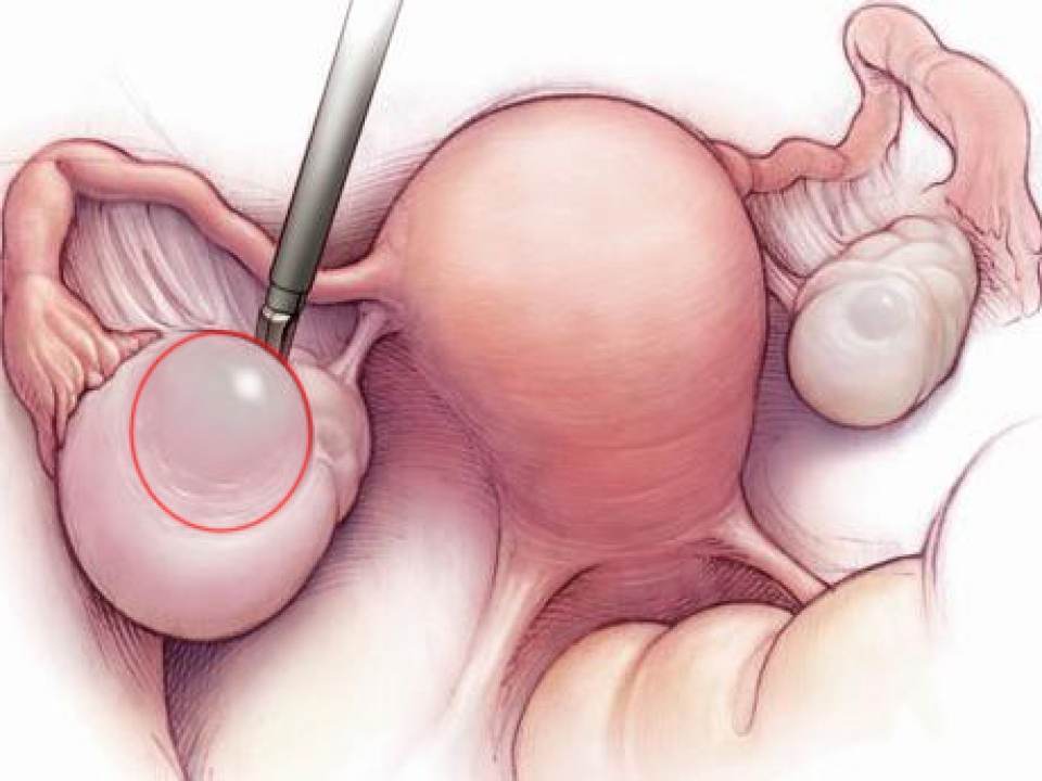 Simptome ale cancerului ovarian pe care femeile nu le baga in seama niciodata