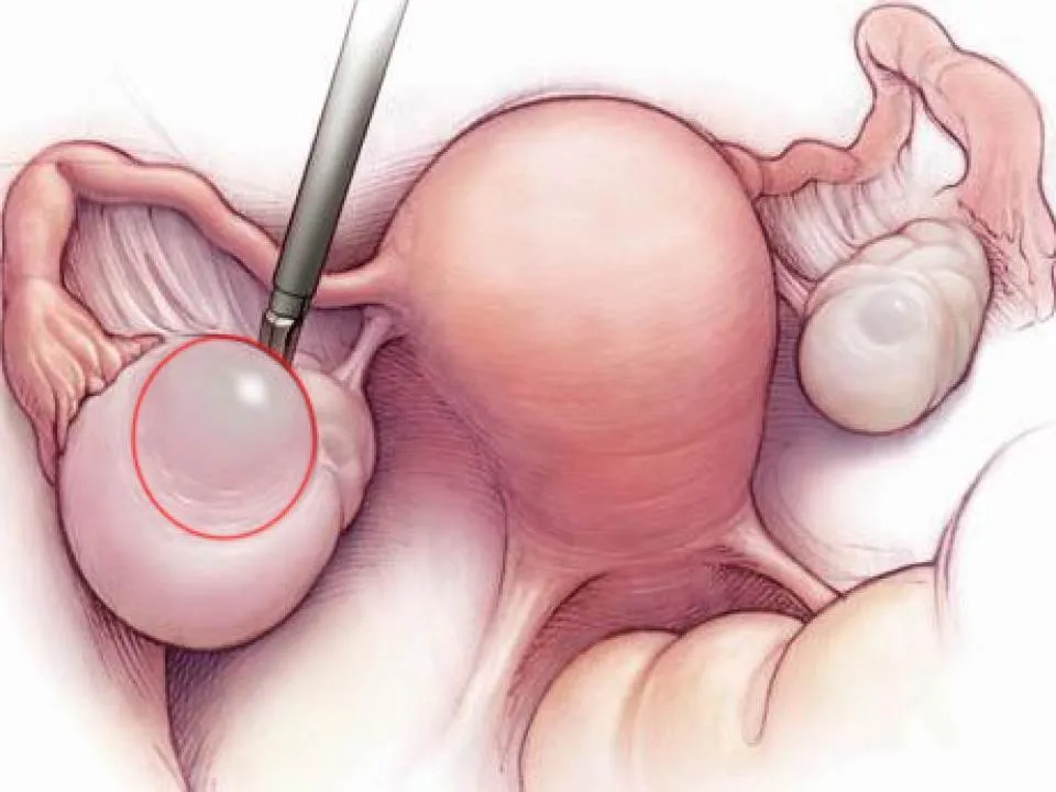 Simptome ale cancerului ovarian pe care femeile nu le baga in seama niciodata