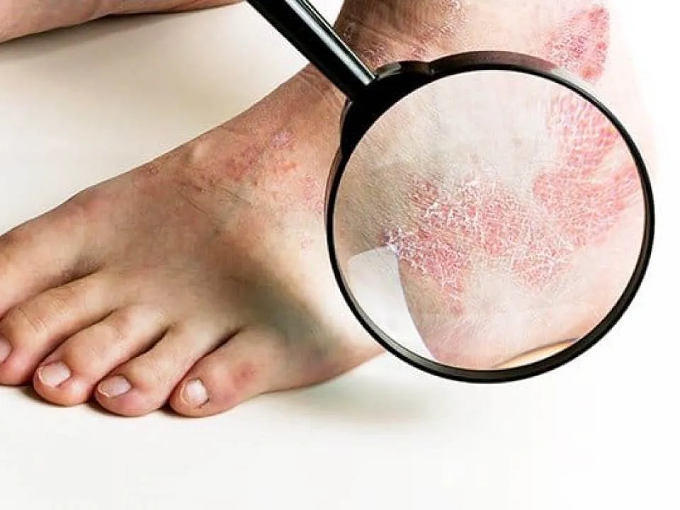 Remedii de casa pentru psoriazis pe picioare
