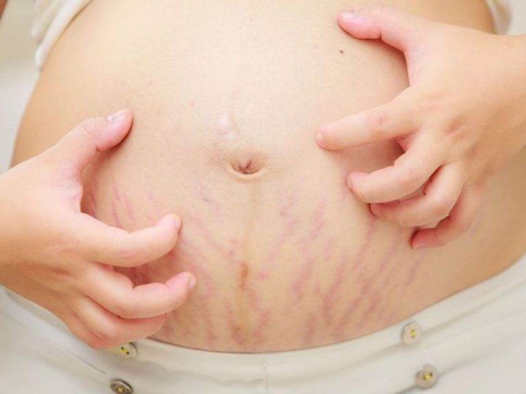 Metode aprobate de dermatolog pentru a scapa de vergeturile lasate de sarcina
