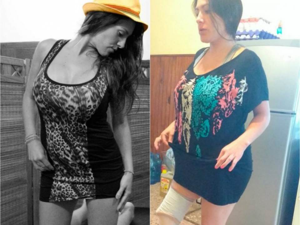 Liposuctia: ce trebuie sa stii pentru a evita riscurile! Povestea tinerei care a ramas fara un picior in urma interventiei