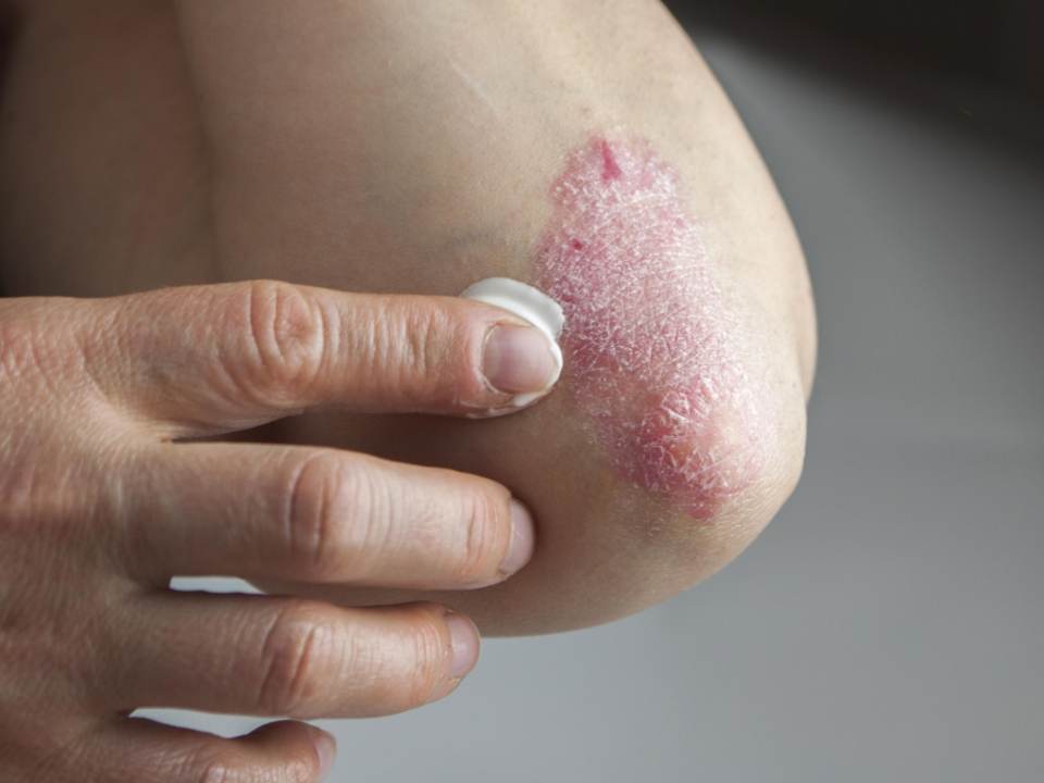 Cum sa scapi de o eczema pe cale naturala