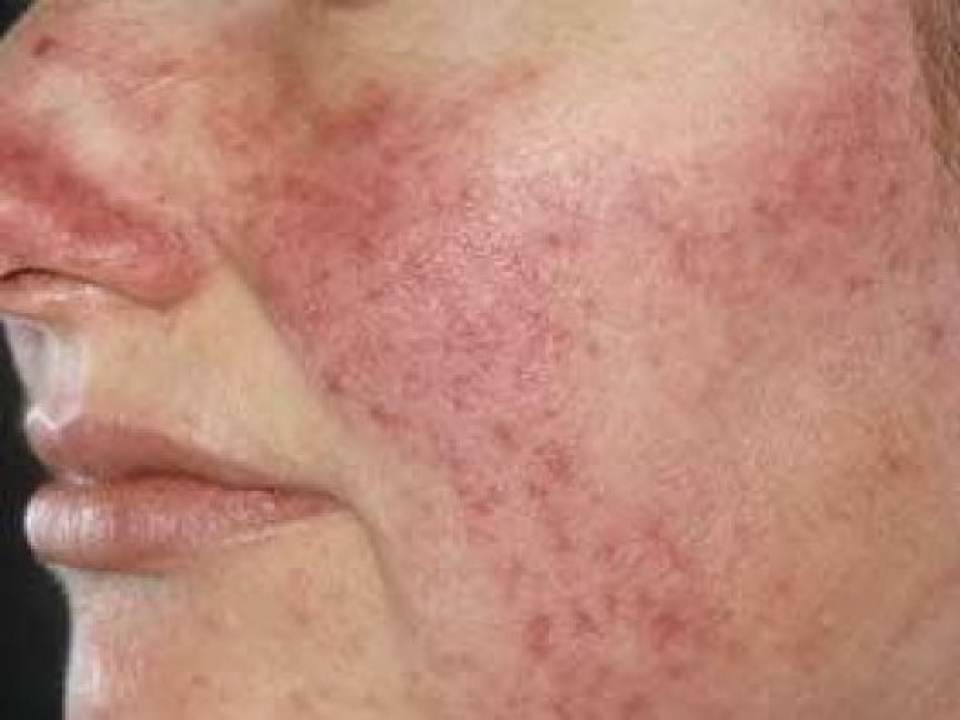 Uleiuri esentiale pentru rozacee