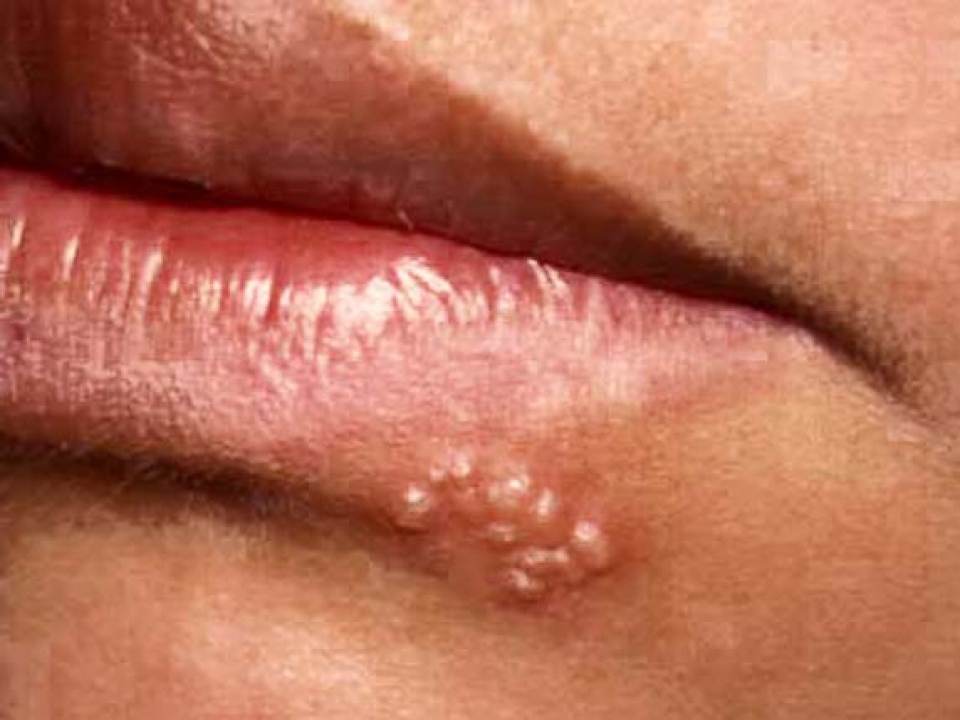 Lucruri pe care ar trebui sa le stii despre herpesul bucal