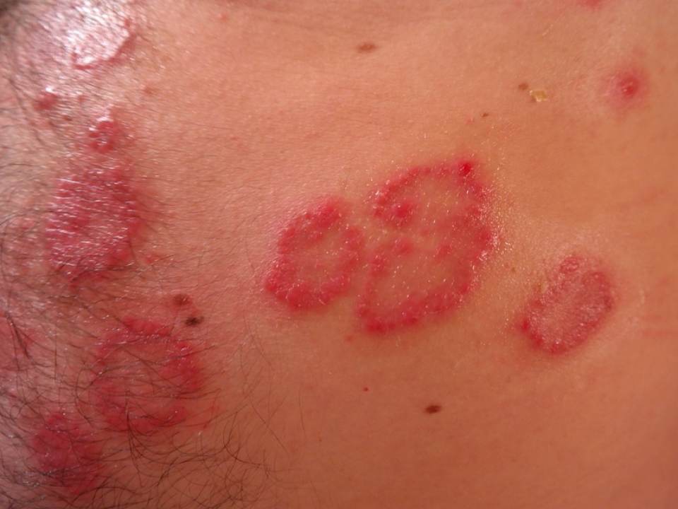 Lucruri de evitat daca ai psoriazis