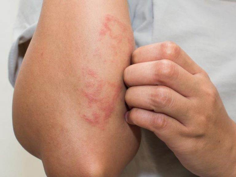 Ce sa mananci daca suferi de eczema