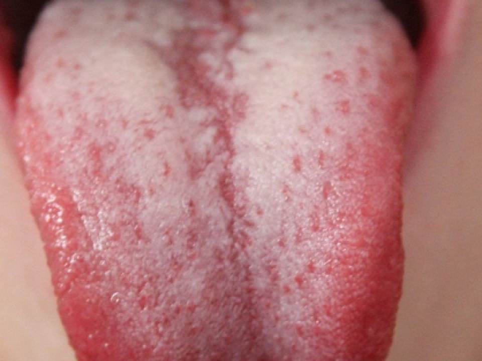Simptome si cauzele limbii albe! Cum sa tratezi infectia acasa