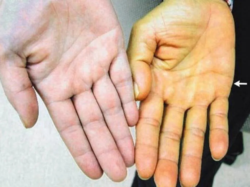 Semne ca ficatul tau sufera! Ai grija, nu e de glumit