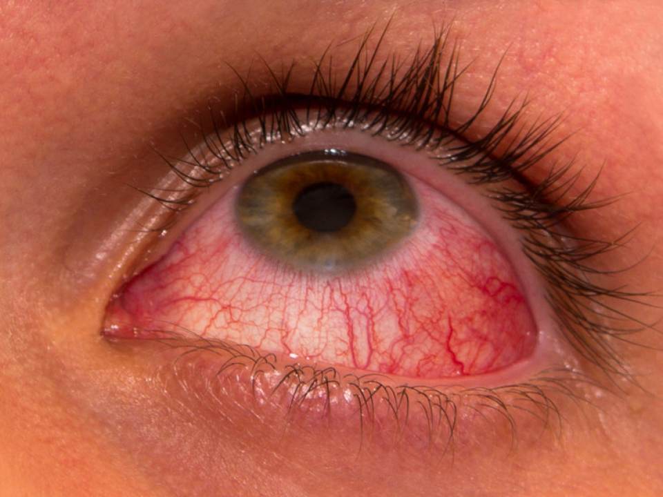 De ce ti se inrosesc ochii! Principalele probleme care ii pot afecta