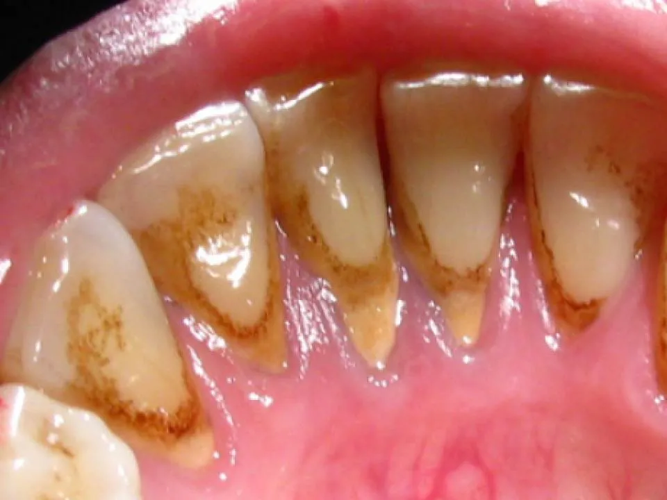 Cum poti sa scapi rapid de tartrul dentar – retete simple si rapide pentru dinti albi