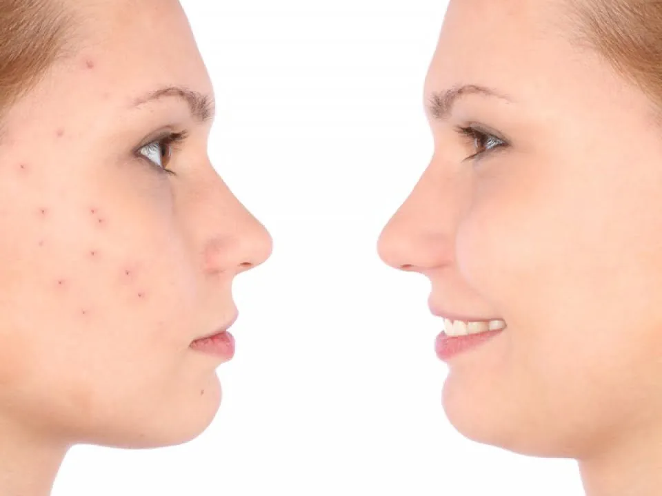Cum sa ai un ten lipsit de imperfectiuni! Masti de fata pe care trebuie sa le incerci
