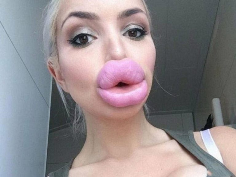 Imagini socante gasite pe Instagram! Mai multe bloggerite au exagerat cu acidul in buze iar rezultatele sunt dezastruase