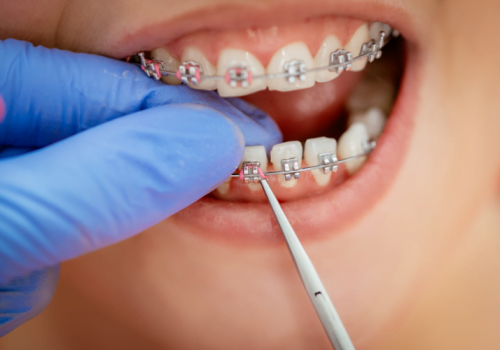 Care sunt semnele care indică faptul că micuțul tău are nevoie de un aparat dentar?