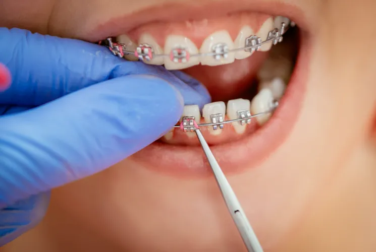 Care sunt semnele care indică faptul că micuțul tău are nevoie de un aparat dentar?