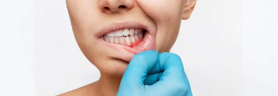 Atenţie! Sângerările gingivale pot fi semn de leucemie