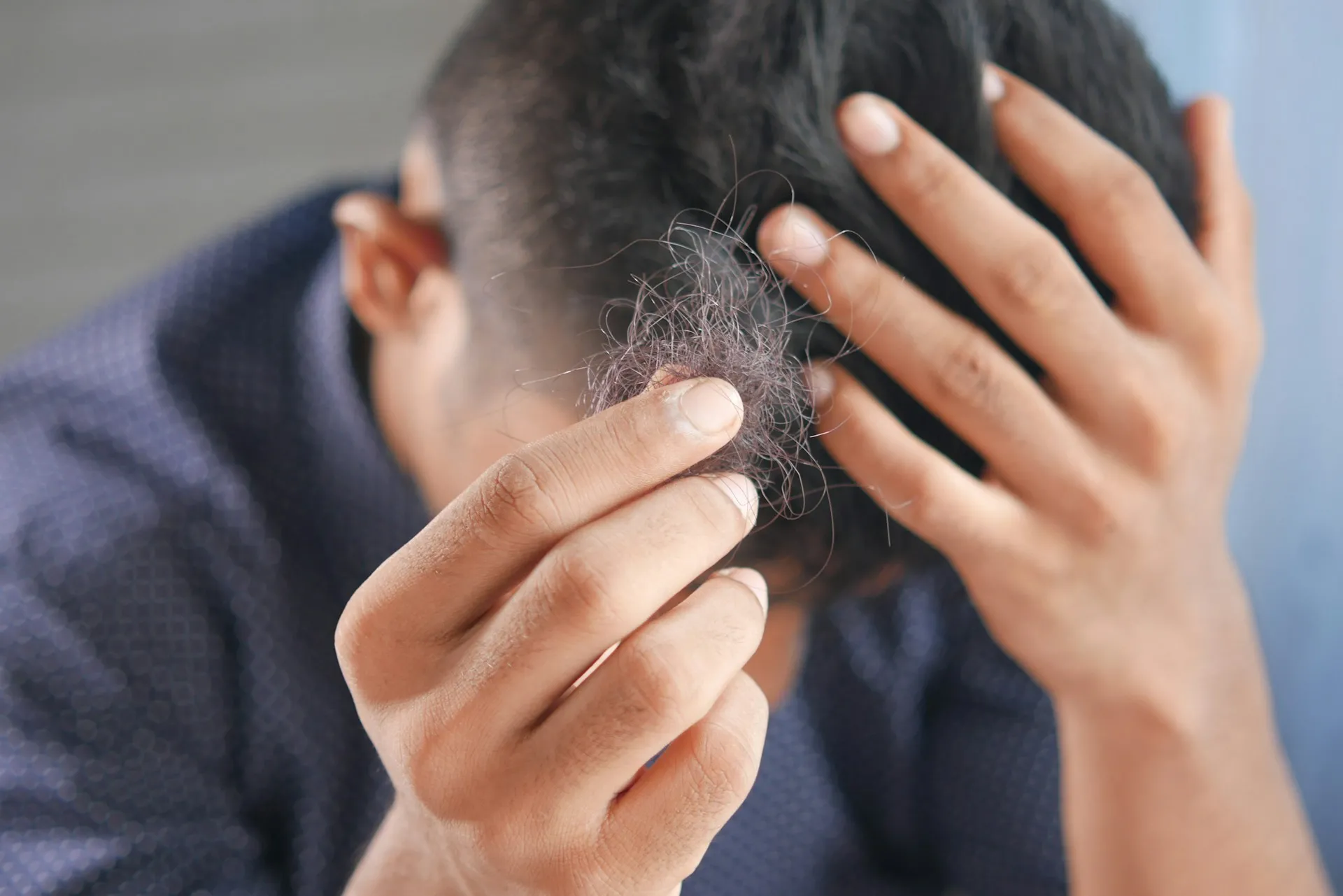 Ce este alopecia: cauze, forme și soluții