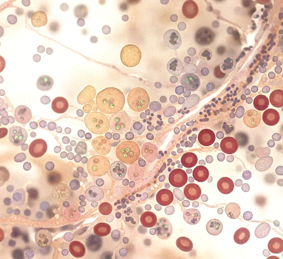 Ce schimbări ascunse apar în măduva osoasă cu mult timp înainte de boală