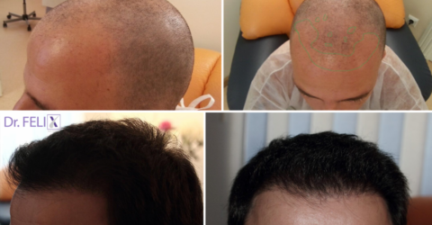 Nu e vanitate, e identitate: ce înseamnă operația de implant păr la Dr. Felix Hair Implant în 2026?