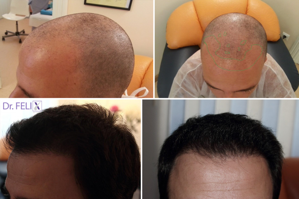 Nu e vanitate, e identitate: ce înseamnă operația de implant păr la Dr. Felix Hair Implant în 2026?