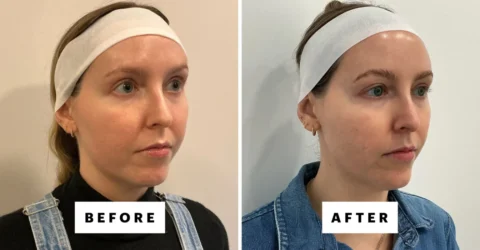 XERF, procedura de 2.000 de dolari care strange pielea fara durere si e iubita de vedete