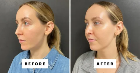 Injecțiile cu acid hialuronic în bărbie, o alternativă la chirurgie. Sfaturi utile înainte de procedură.