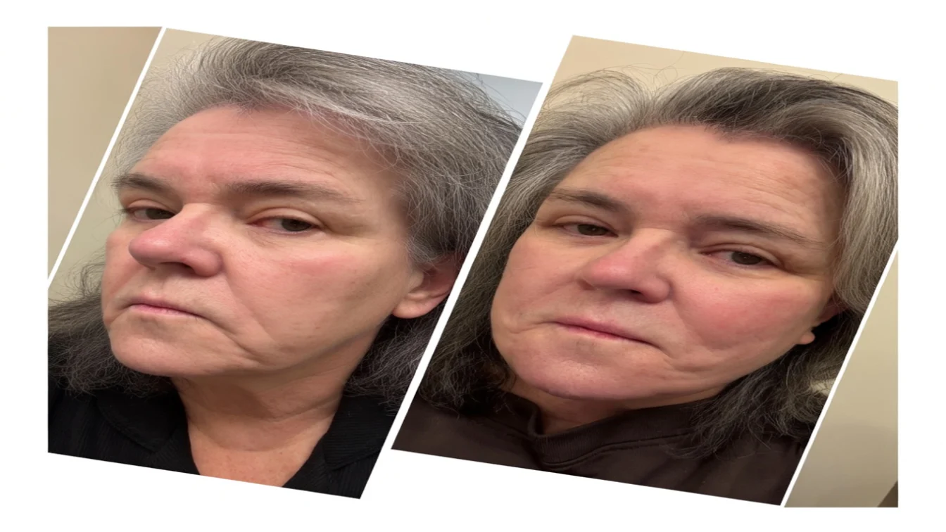 split photo of rosie o'donnell before and after facelift