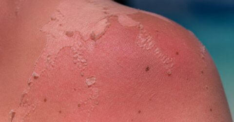 Cinci arsuri solare îți pot dubla riscul de melanom. Ce spun medicii despre pericolul real