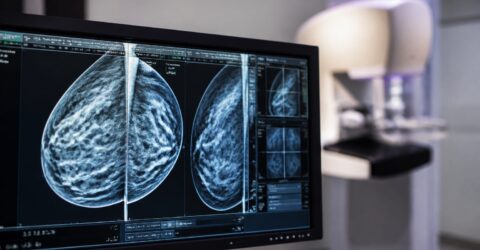 Cancerul de sân, depistat mai precis cu ajutorul inteligenței artificiale. Mamografia ar putea urmări riscul în timp